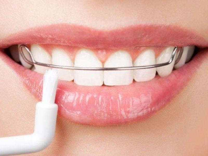 Depois do aparelho: entenda a contenção e como evitar que os dentes voltem a se movimentar
