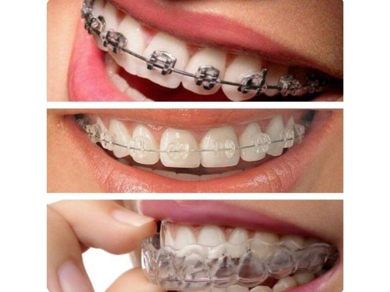 Alinhador transparente x aparelho fixo qual é melhor para o seu caso