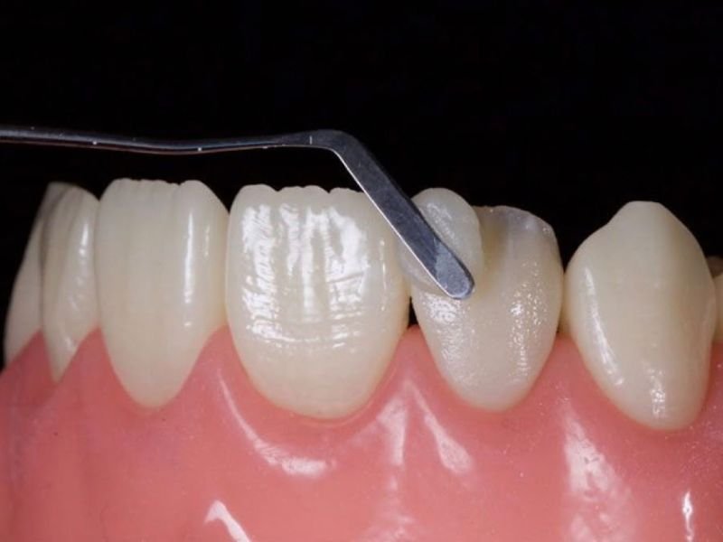 Vale a Pena Fazer Facetas em Resina? Conheça as Vantagens, Desvantagens e Cuidados