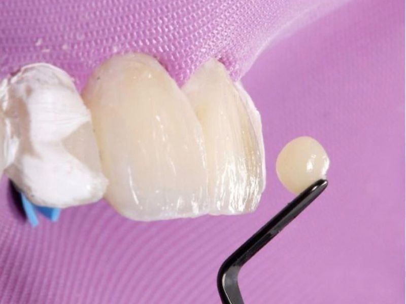 Facetas em Resina Duram Quanto Tempo? 7 Fatores Que Influenciam a Durabilidade