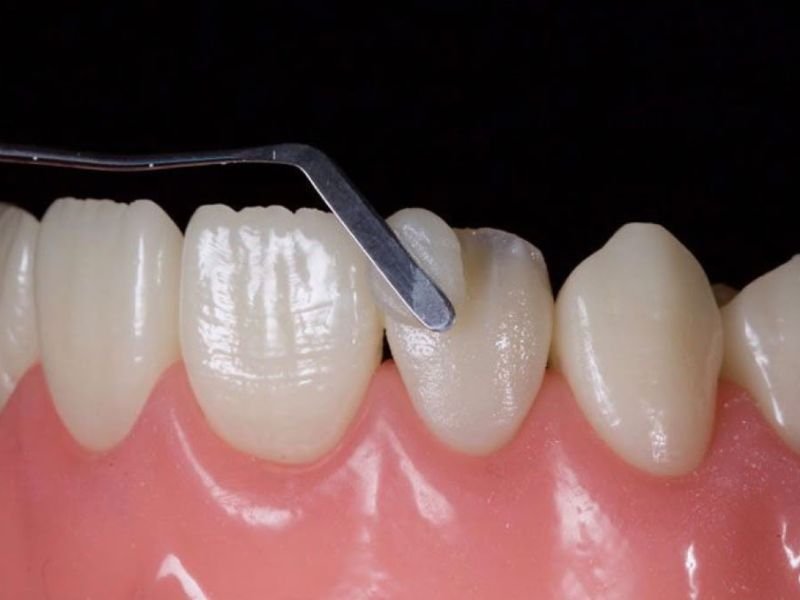 Facetas em Resina Doem? Entenda Como é Feito o Procedimento no Consultório Odontológico