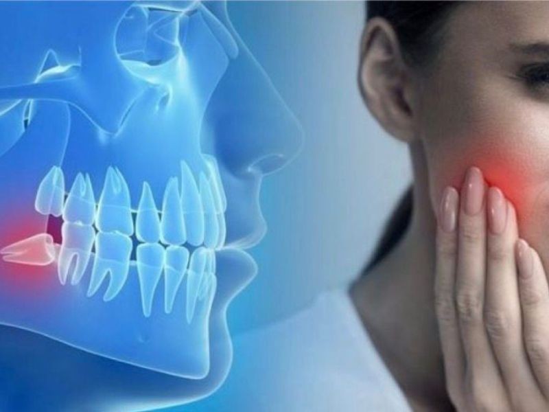 Extração do dente siso: quando é necessária, como funciona e cuidados após a cirurgia