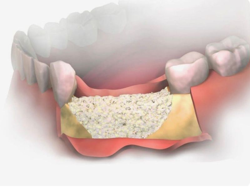 Quando é necessário fazer enxerto ósseo para implante dentário?