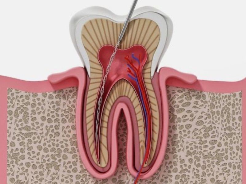 Quando é necessário fazer canal no dente?