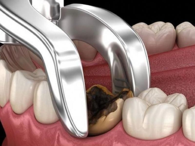 Quando é necessário extrair o dente do siso Sinais que indicam cirurgia