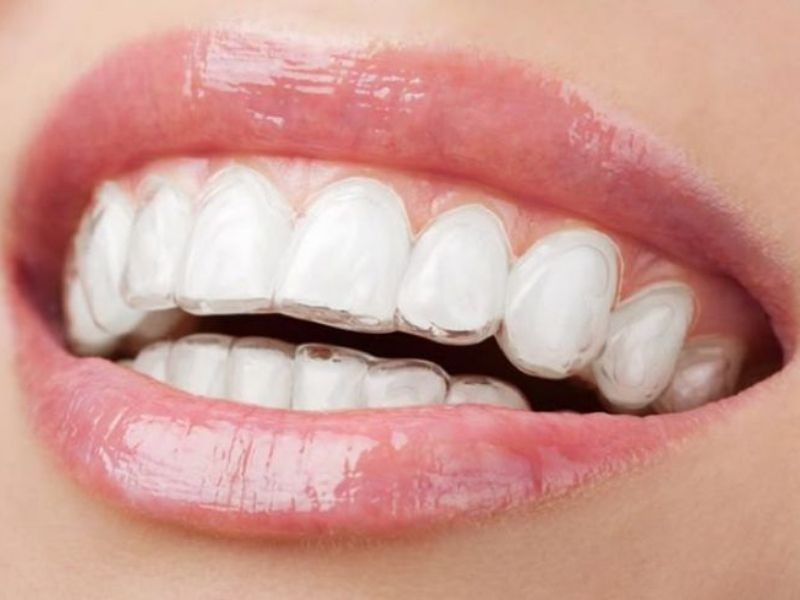 Adultos podem usar aparelho ortodôntico? Vantagens, limitações e cuidados