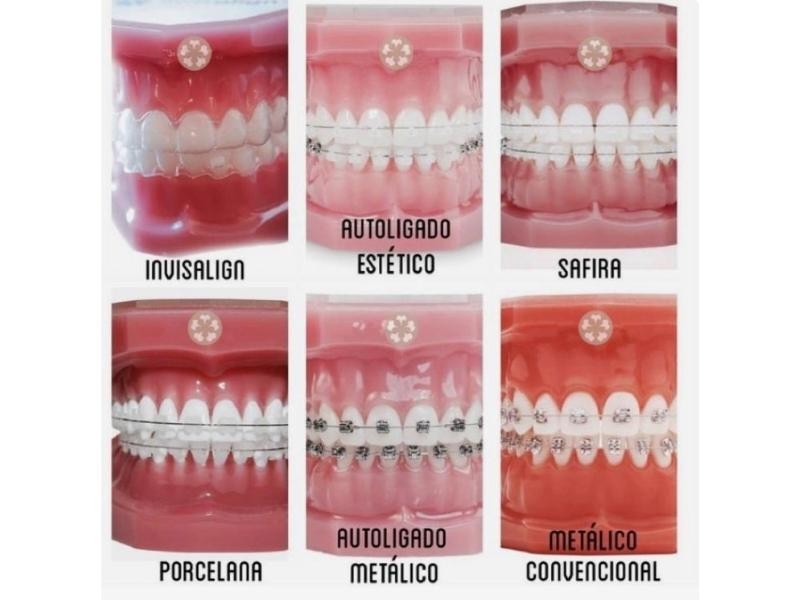 Quais os tipos de aparelho ortodôntico e como escolher o ideal para você