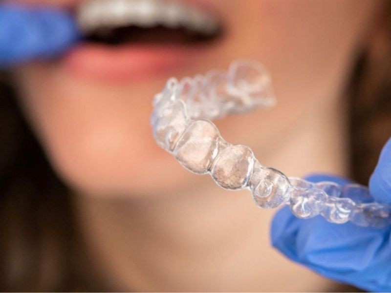 Alinhadores Estéticos: Como é o Processo de Tratamento do Início ao Fim (Passo a Passo)