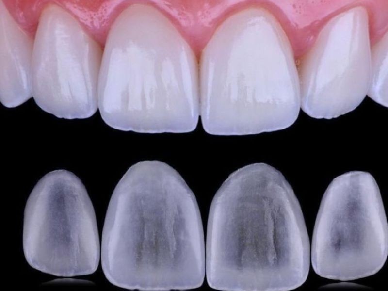 Facetas Dentárias: O Que São, Tipos e Como Melhoram Seu Sorriso