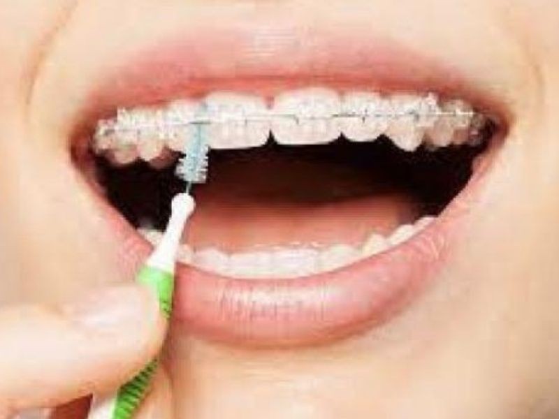 Cuidados diários com o aparelho ortodôntico: alimentação, escovação e visitas ao ortodontista