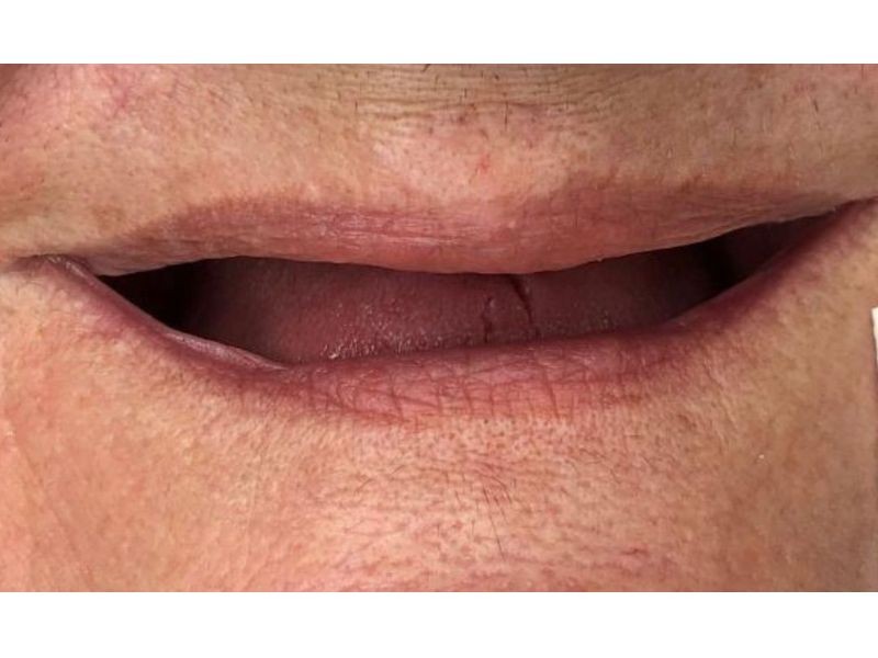 Perdi Todos os Dentes: Quais Tratamentos Tenho à Disposição?