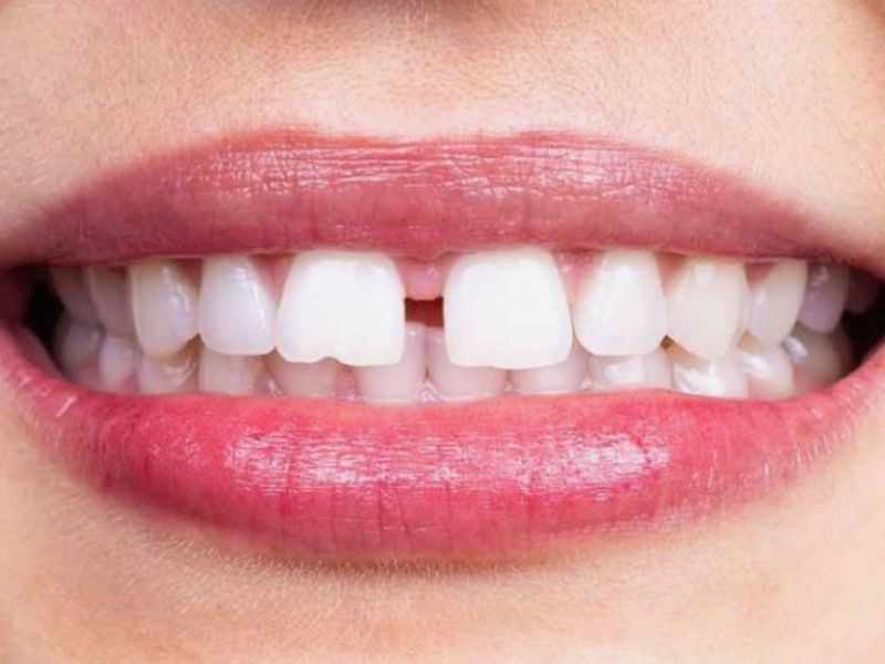 Você sabe o que é diastema?