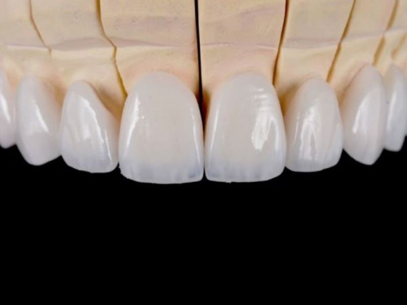 Facetas dentárias doem? Mitos, verdades e o que esperar no pós‑procedimento