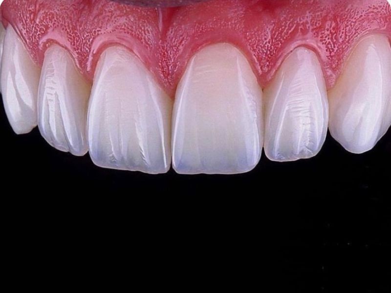 Facetas de porcelana X facetas de resina: qual escolher e por quê?