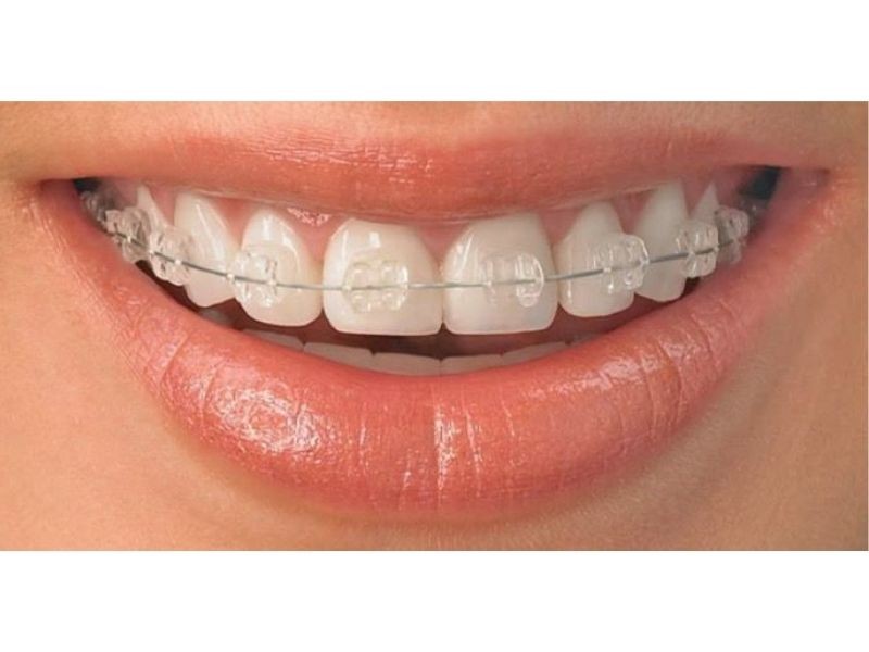 Quanto tempo dura o tratamento com aparelho ortodôntico? Expectativa x realidade