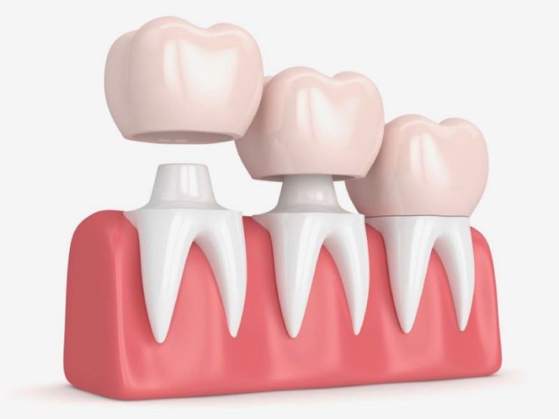 Pino e Coroa: Quando Esse Tratamento Odontológico é Indicado?