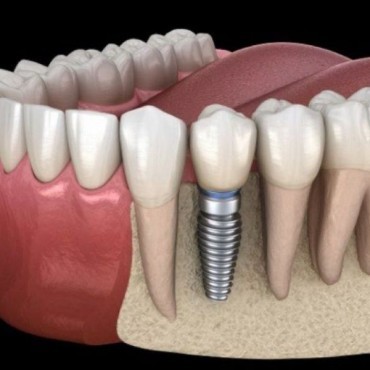 Implantes Dentários em Setor Marista