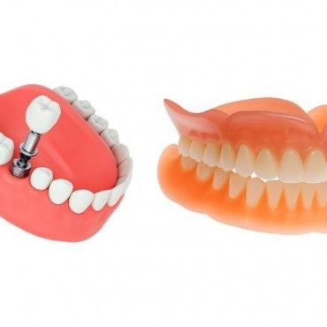 Diferenças entre Dentadura e Protocolo Dentário em Senador Canedo