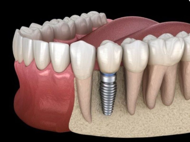 Implantes Dentários