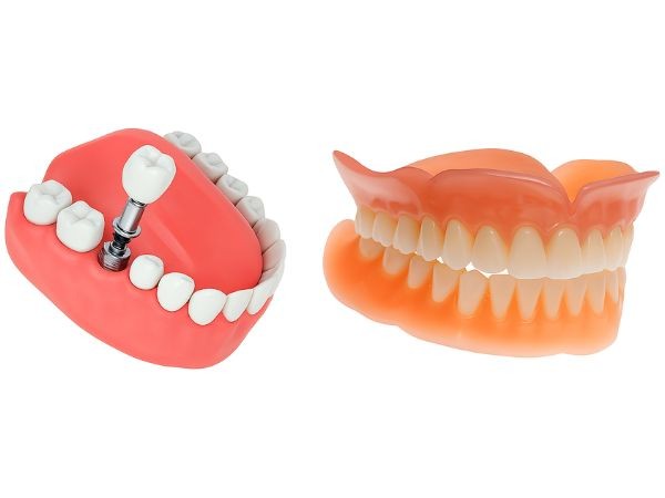 Diferenças entre Dentadura e Protocolo Dentário